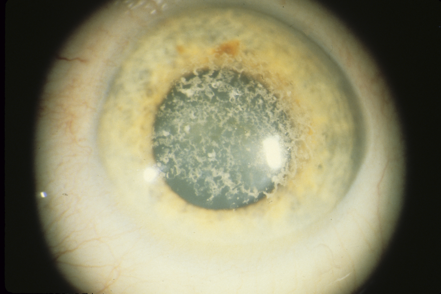 Corneal Lattice Dystrophy