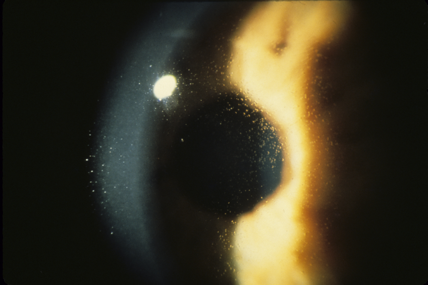 corneal dystrophy corneal dystrophy meesmann hereditary ocular diseases corneal dystrophy corneal dystrophy meesmann hereditary ocular diseases