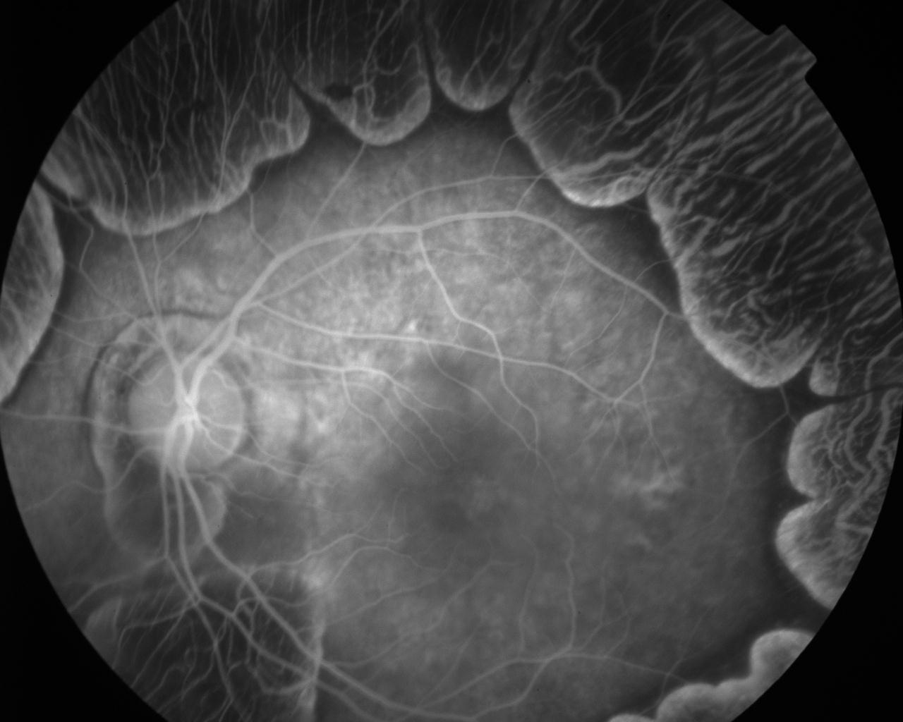 Gyrate Atrophy Hereditary Ocular Diseases