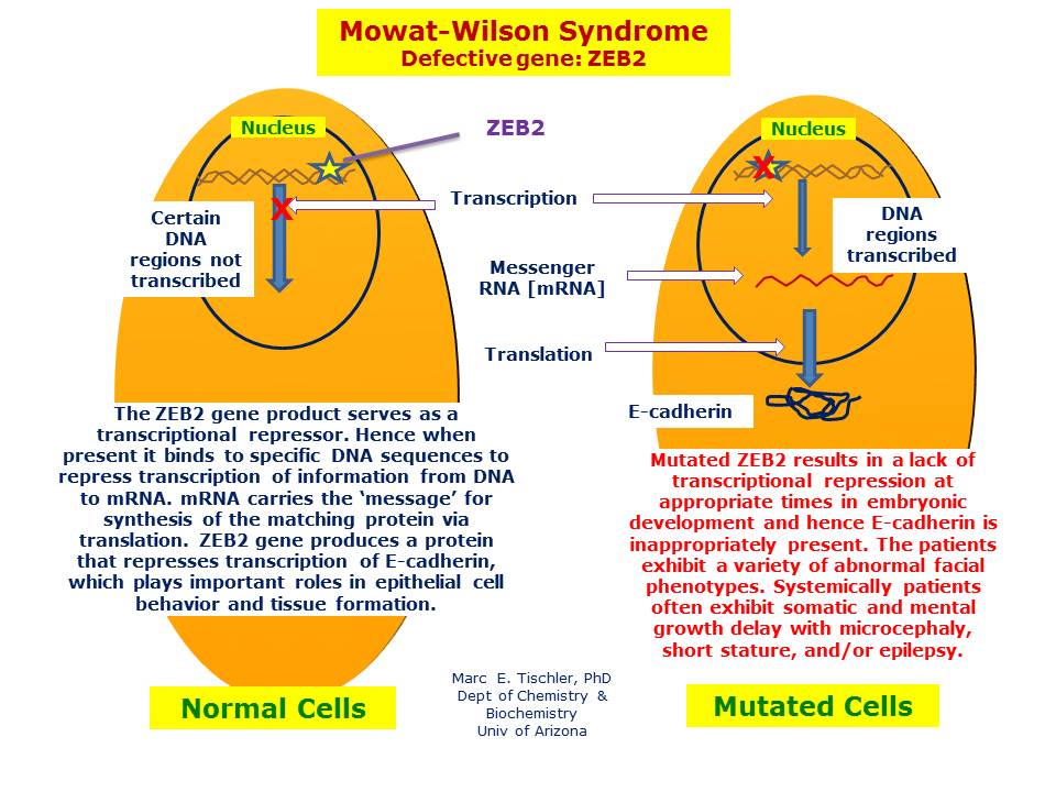 MowatWilson Syndrome Hereditary Ocular Diseases