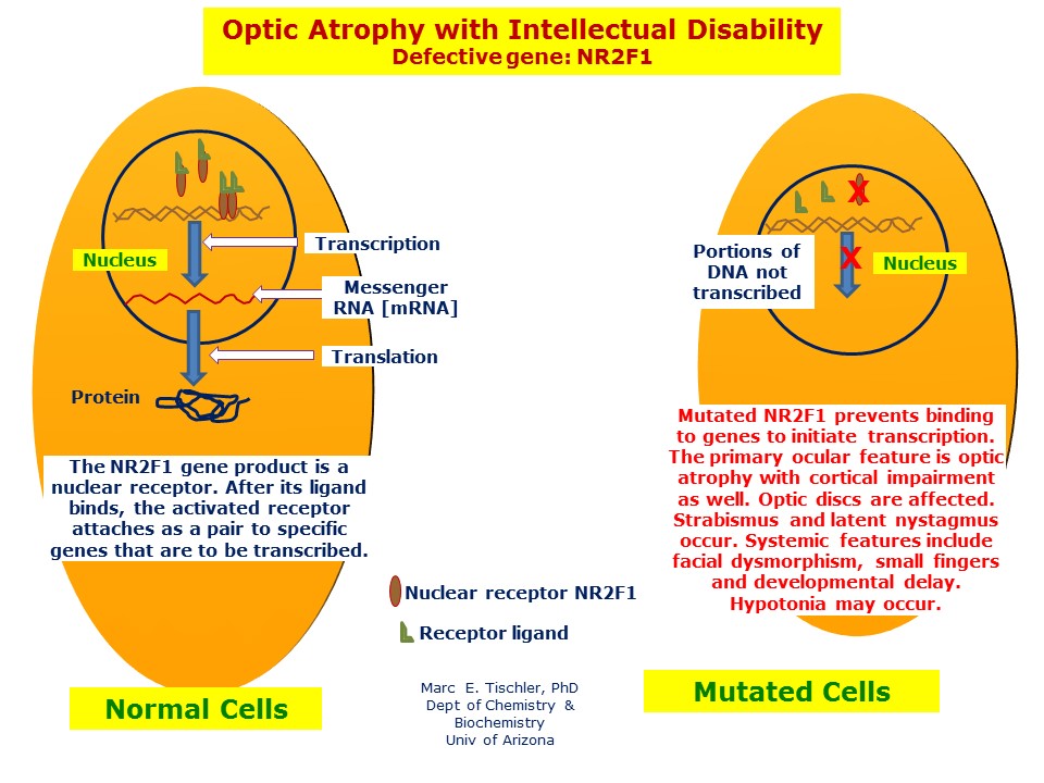 optic-atrophy-with-intellectual-disability-hereditary-ocular-diseases