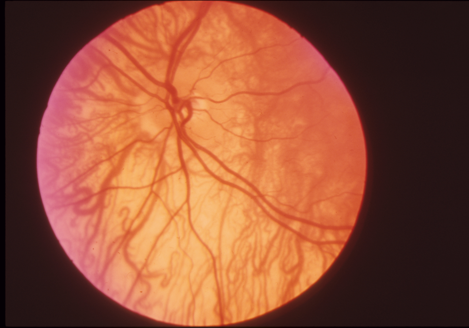 Albinism Ocular