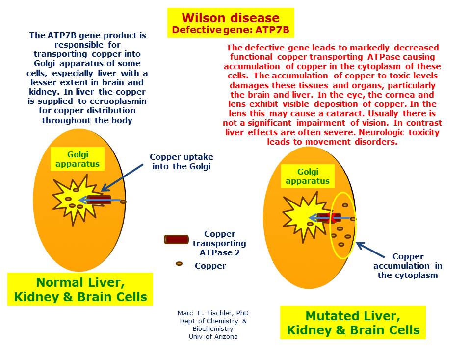 wilson-disease-hereditary-ocular-diseases