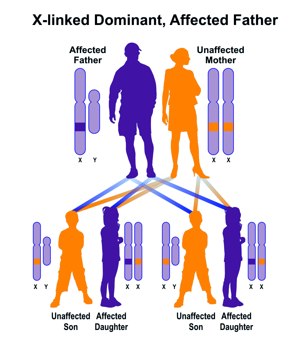 Sanple pedigree of X-linked dominant inheritance, father affected