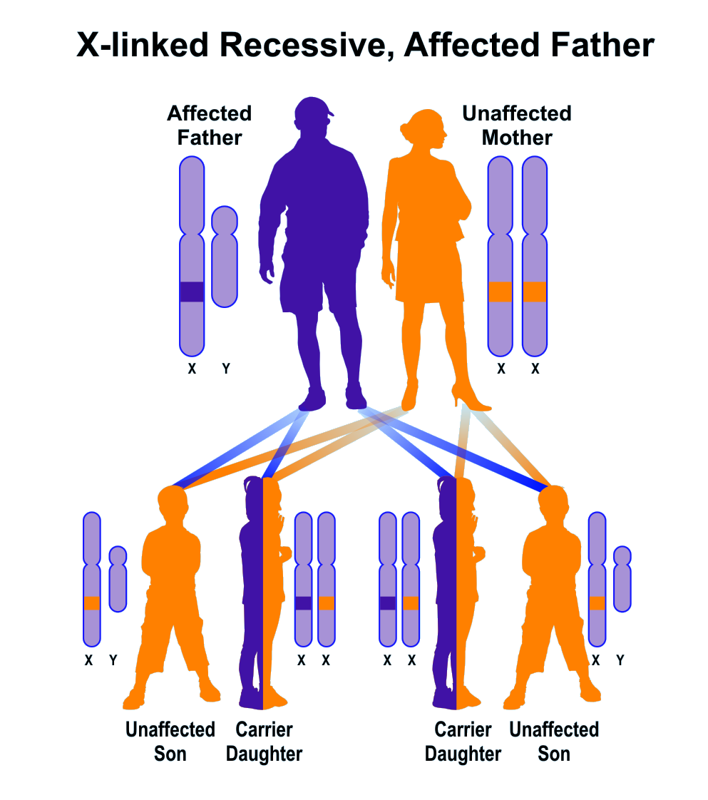 Sample pedigree of X-linked recessive inheritance, father affected