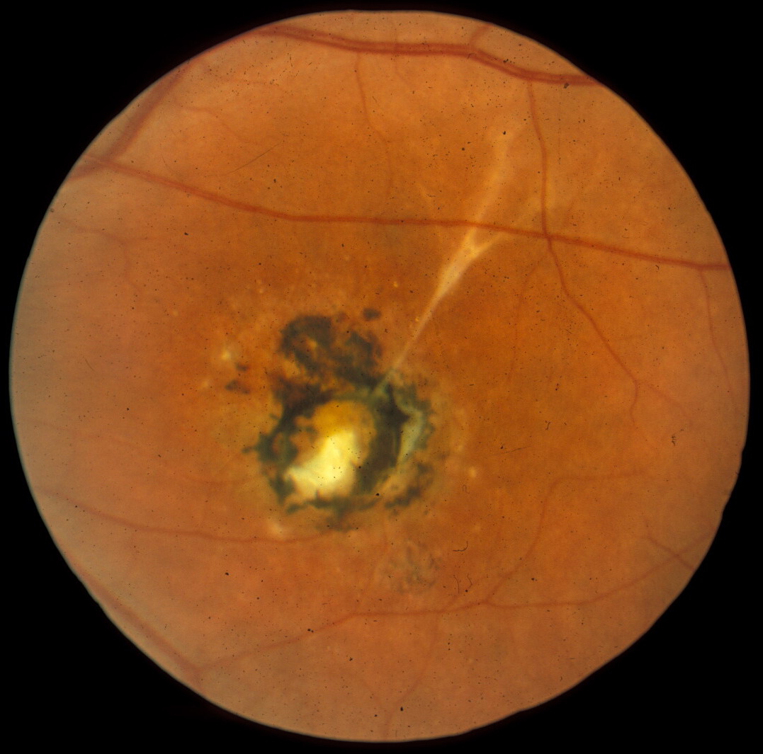 Photo of macular scarring in Best disease