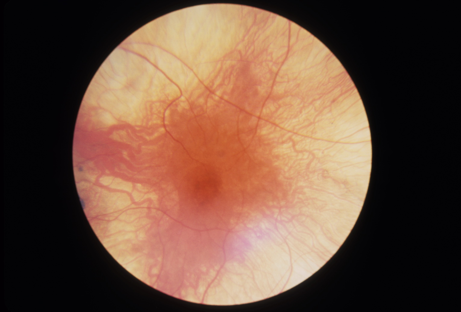 Photograph of macula in choroideremia