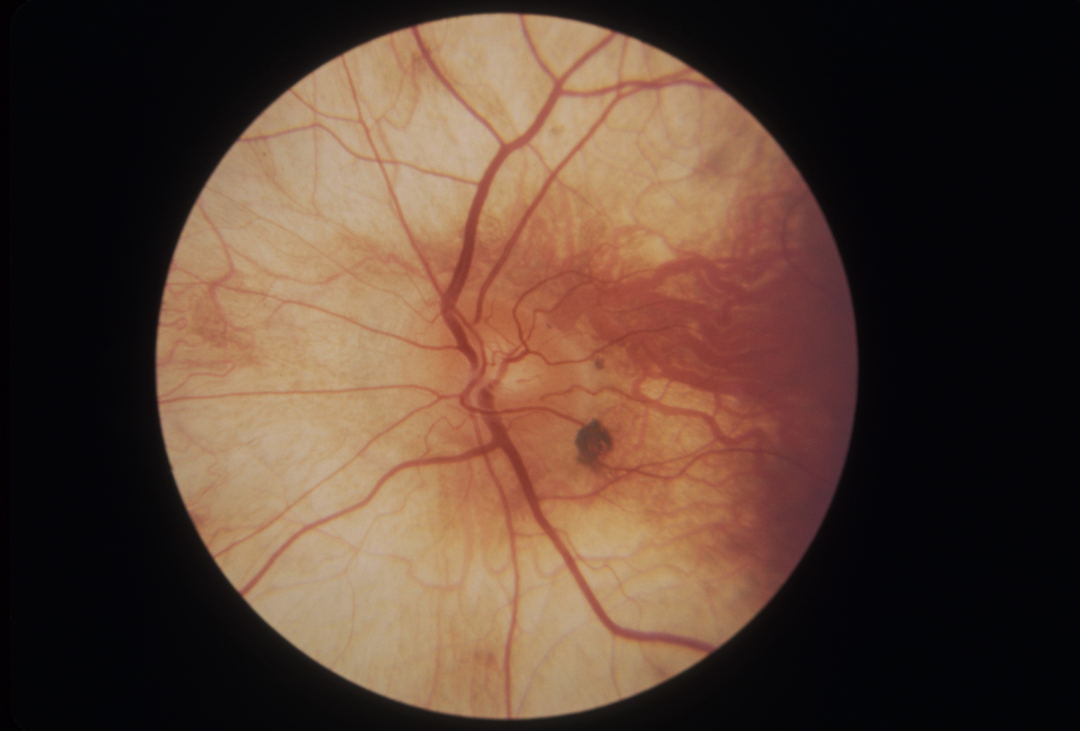 Fundus photograph of disc and fundus in choroideremia