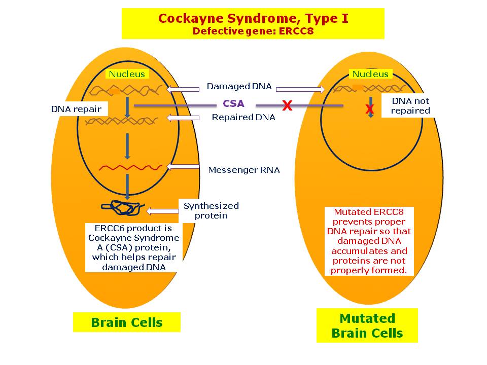 Resultado de imagen de Cockayne syndrome