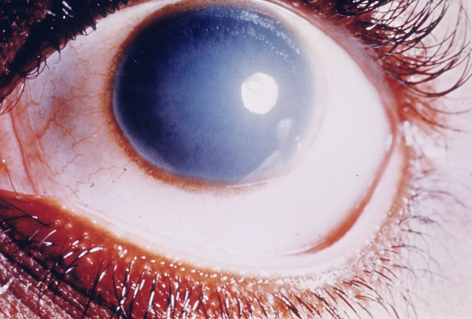 Cloudy cornea in congenital hereditary endothelial dystrophy of the cornea