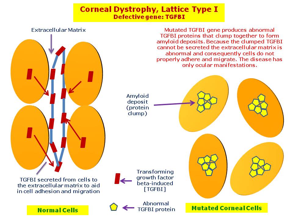 Lattice type I corneal dystrophy results from deposition of abnormal proteins (amyloid) in the cornea