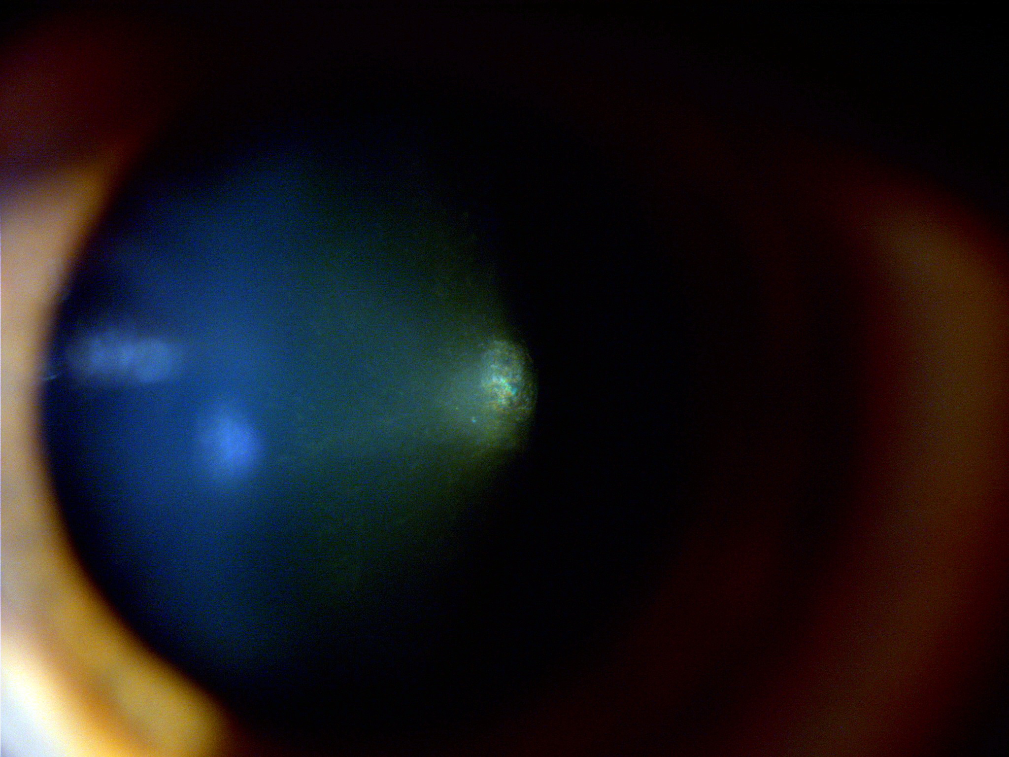 Iridescent lens opacities in a 52 yo patient with myotonic dystrophy