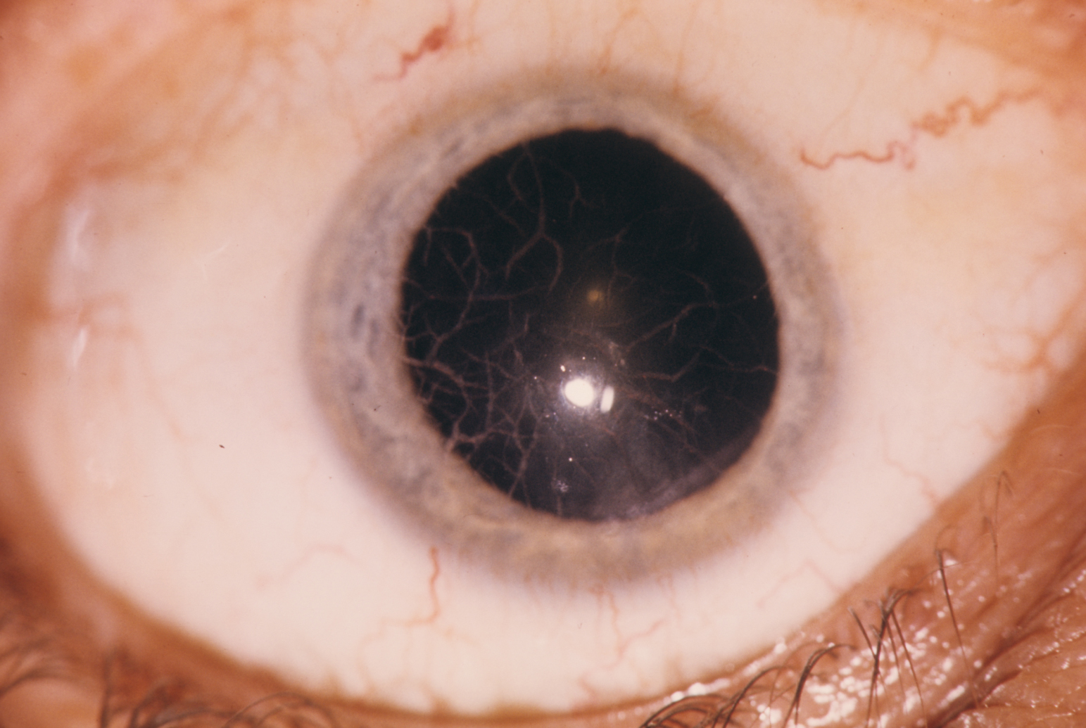 Lattice dystrophy of the cornea