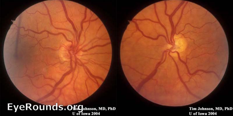 Bilateral optic nerve hypoplasia
