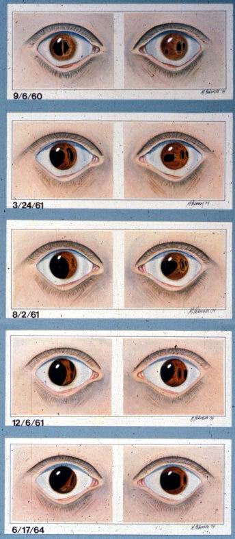 Axenfeld-Rieger Syndrome, Type 1 | Hereditary Ocular Diseases