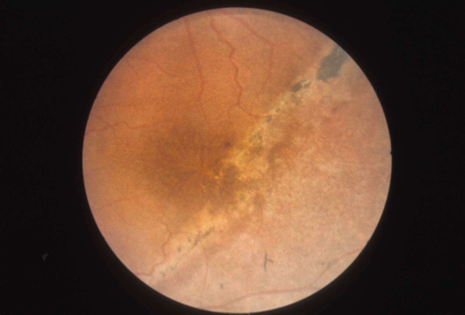 Stellate macula with retinoschisis demarcation line