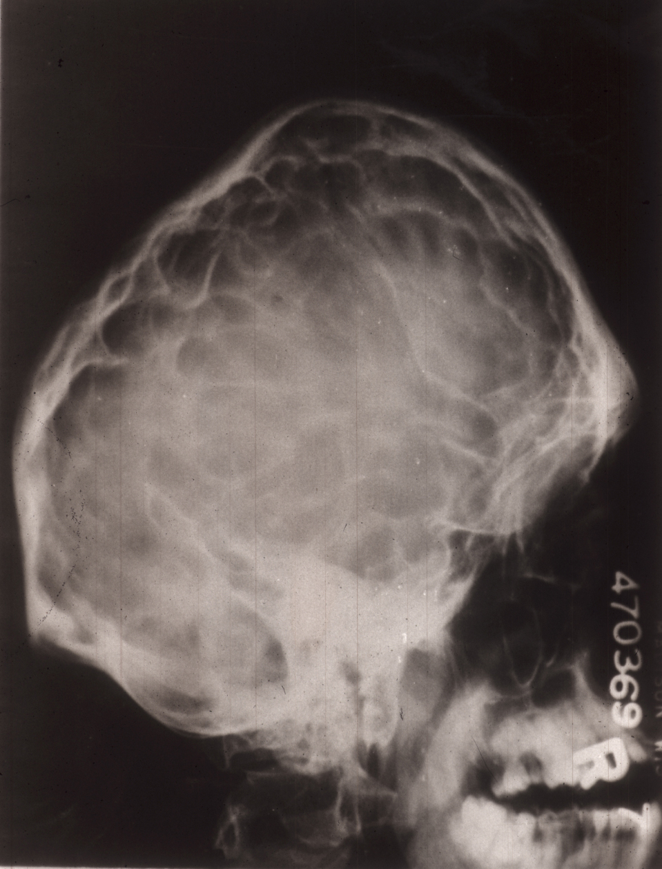 Skull X-ray of adult with Crouzon Syndrome