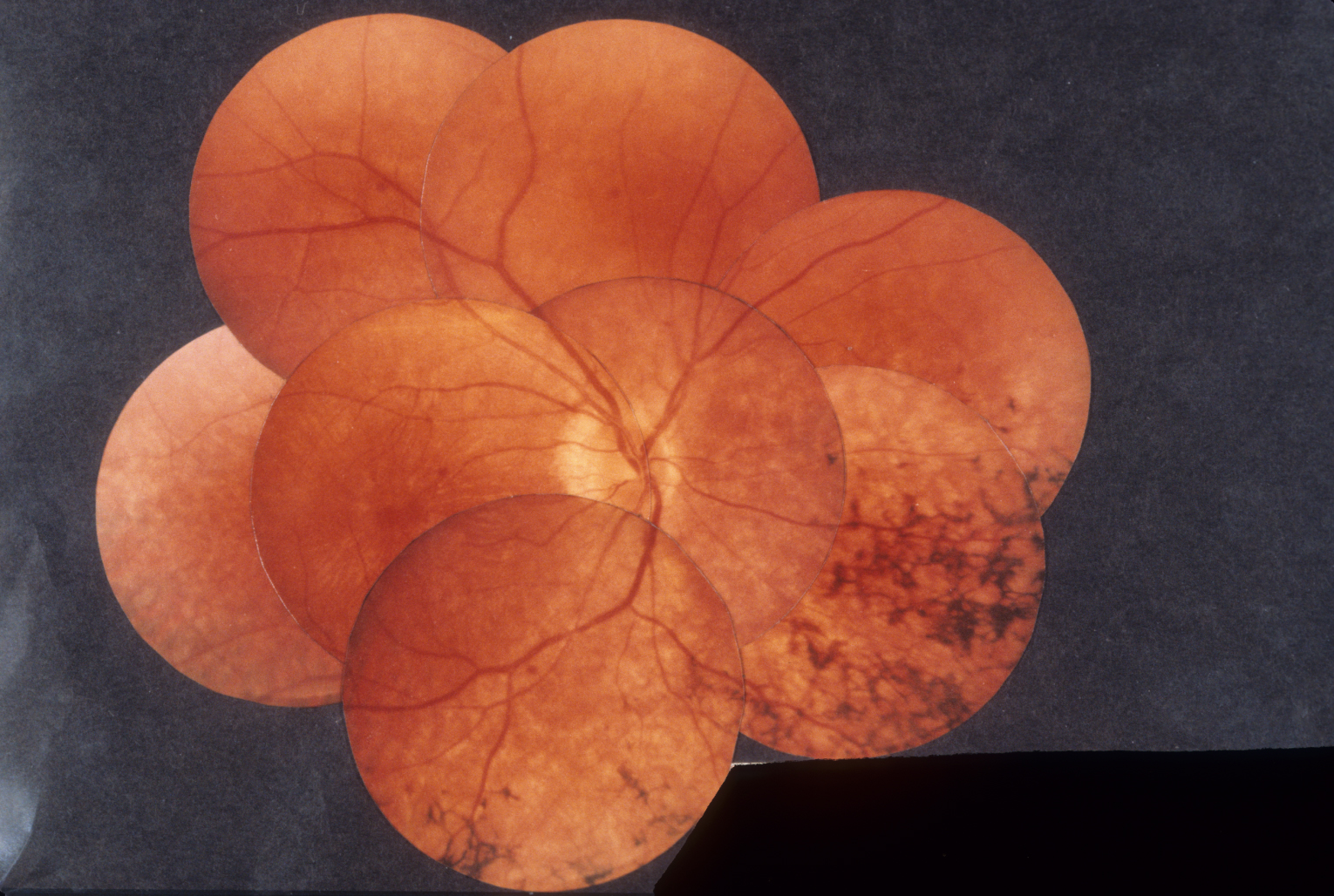 Fundus appearance of retinitis pigmentosa