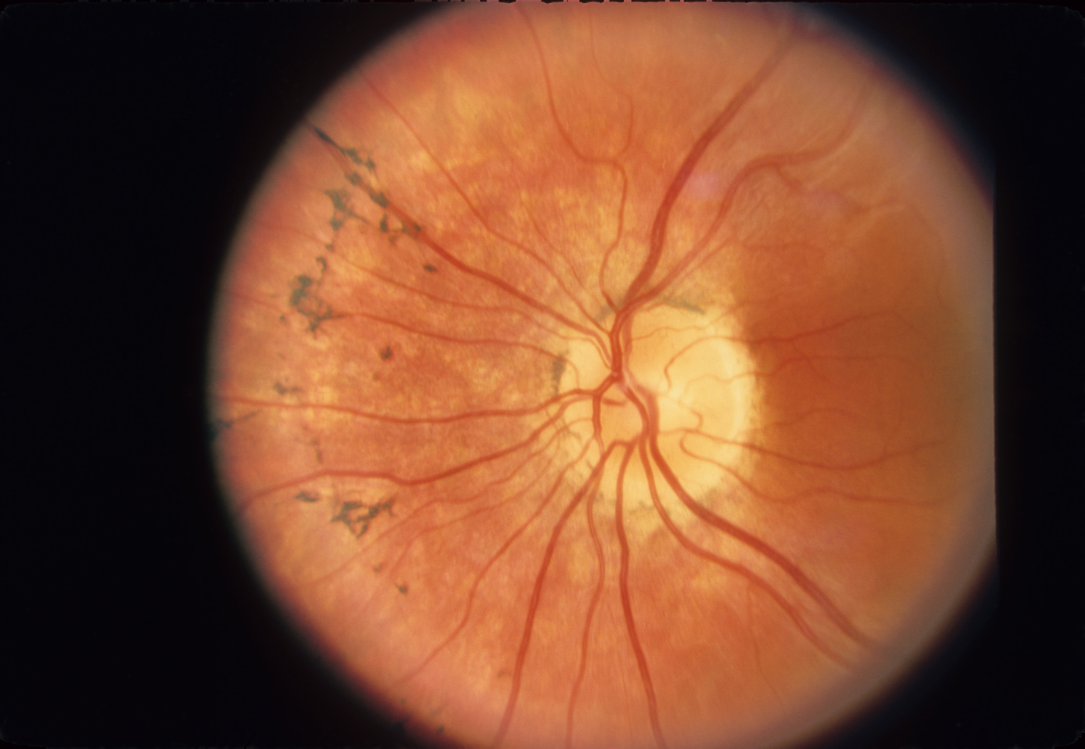 Fundus in autosomal recessive retinitis pigmentosa