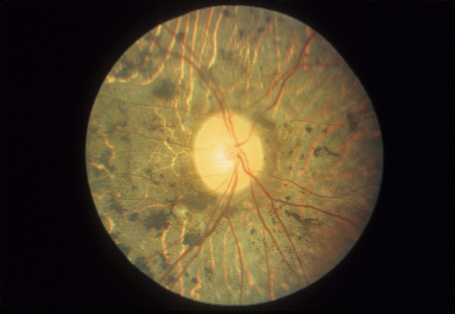 Fundus in autosomal recessive retinitis pigmentosa