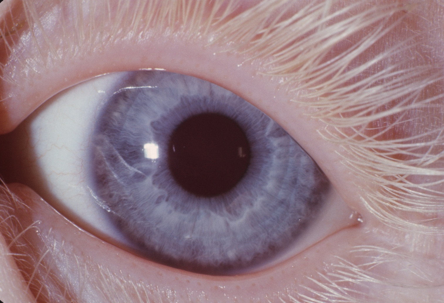 Eye in type IA oculocutaneous albinism