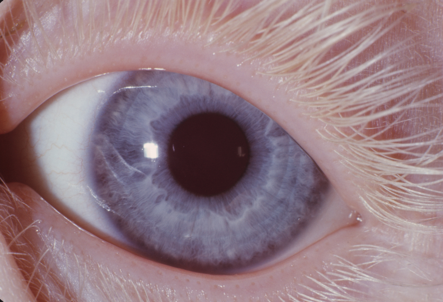 Albinism Oculocutaneous Type I Hereditary Ocular Diseases