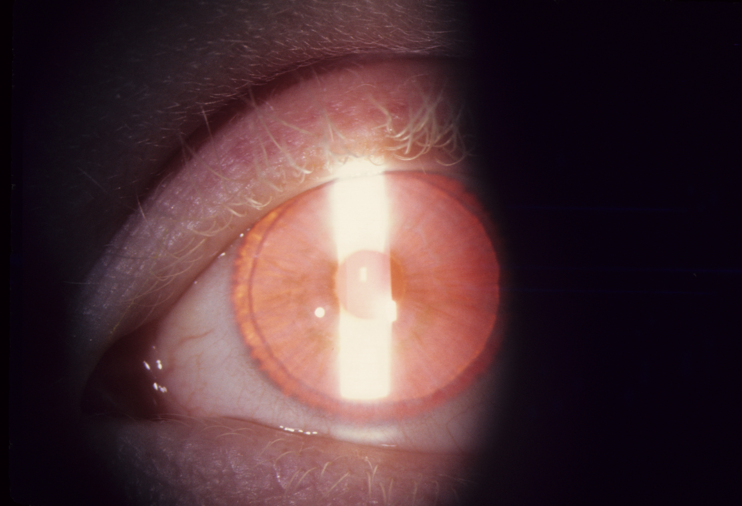 albinism-oculocutaneous-type-i-hereditary-ocular-diseases