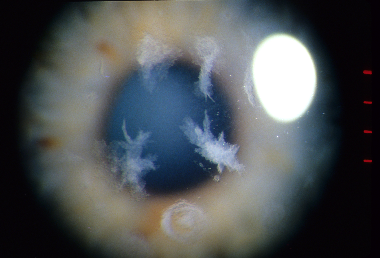 Central corneal crystals in Schnyder corneal dystrophy