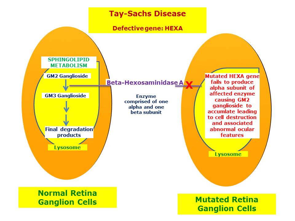 Tay-Sachs Disease: Signs and Symptoms