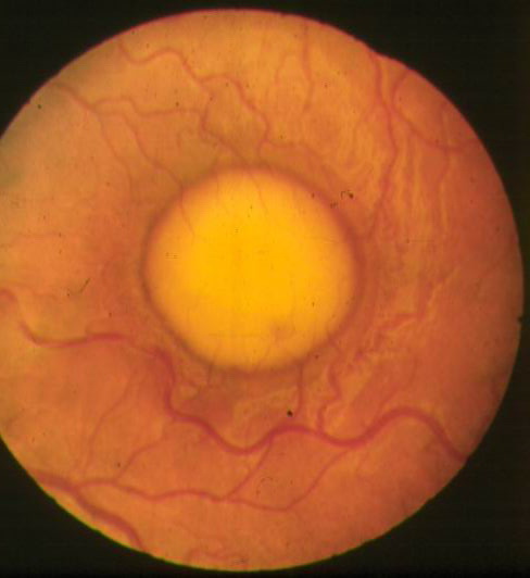 Photo of Vitelliform macular lesion
