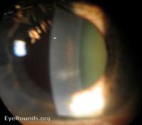 Glaucoma, Pigment Dispersion Syndrome | Hereditary Ocular Diseases