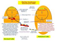 Marfan Syndrome | Hereditary Ocular Diseases